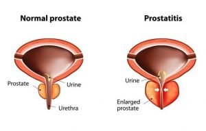 Read more about the article Operasi Prostat Batal Karena Sembuh Setelah Minum Minyak Kelapa Murni