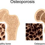 Osteoporosis Bukanlah Penyakit Kekurangan Kalsium!